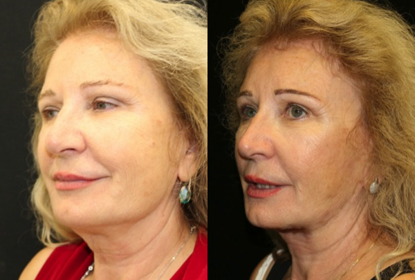 Facelift Before and After Photo by Dr. Roger Tsai in Beverly Hills