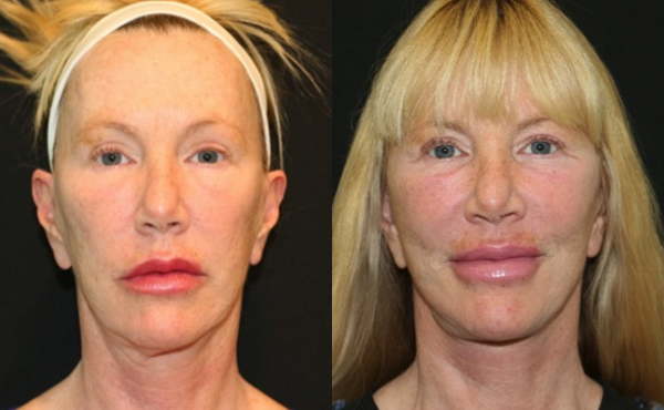 Facelift Before and After Photo by Dr. Roger Tsai in Beverly Hills