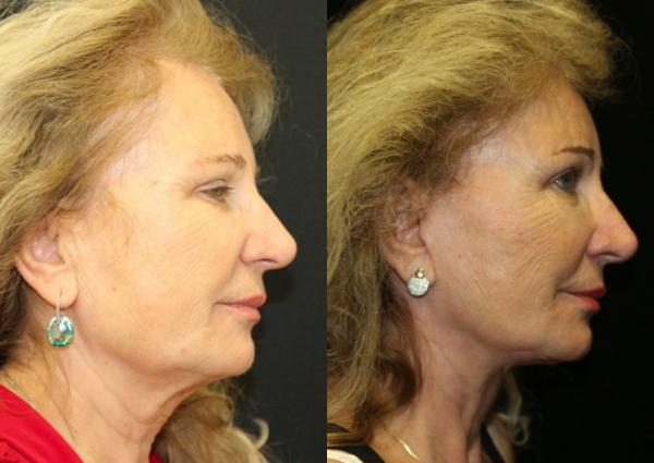 Brow Lift Before and After Photo by Dr. Roger Tsai in Beverly Hills