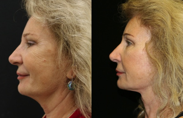 Brow Lift Before and After Photo by Dr. Roger Tsai in Beverly Hills