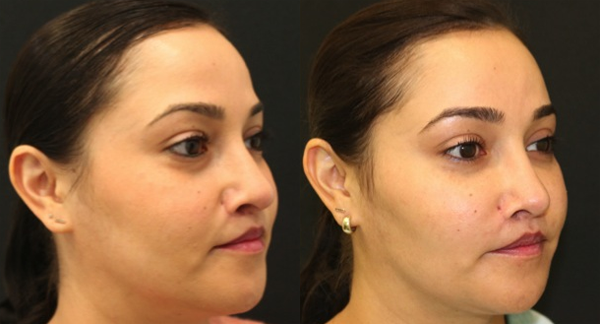 Buccal Lipectomy Before and After Photo by Dr. Roger Tsai in Beverly Hills