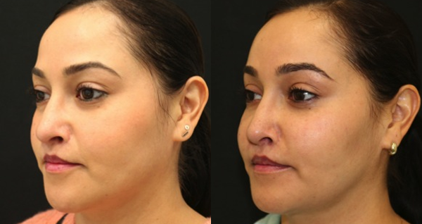 Buccal Lipectomy Before and After Photo by Dr. Roger Tsai in Beverly Hills