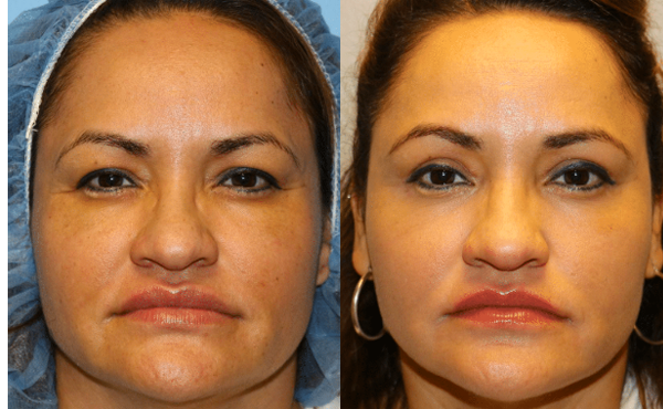 Eyelid Surgery (Blepharoplasty) Before and After Photo by Dr. Roger Tsai in Beverly Hills