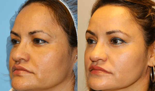 Eyelid Surgery (Blepharoplasty) Before and After Photo by Dr. Roger Tsai in Beverly Hills