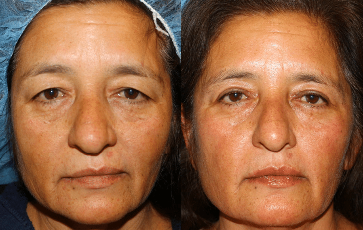 Eyelid Surgery (Blepharoplasty) Before and After Photo by Dr. Roger Tsai in Beverly Hills