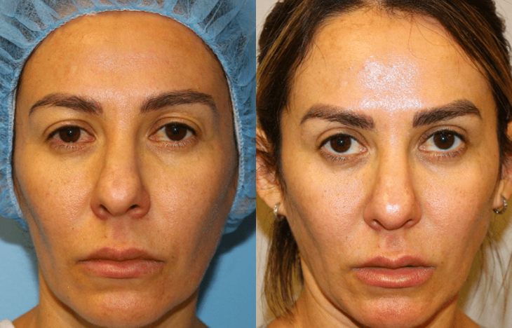 Eyelid Surgery (Blepharoplasty) Before and After Photo by Dr. Roger Tsai in Beverly Hills