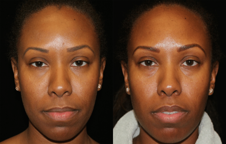 Eyelid Surgery (Blepharoplasty) Before and After Photo by Dr. Roger Tsai in Beverly Hills