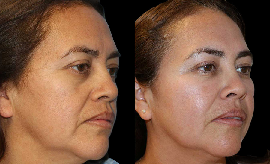 Eyelid Surgery (Blepharoplasty) Before and After Photo by Dr. Roger Tsai in Beverly Hills