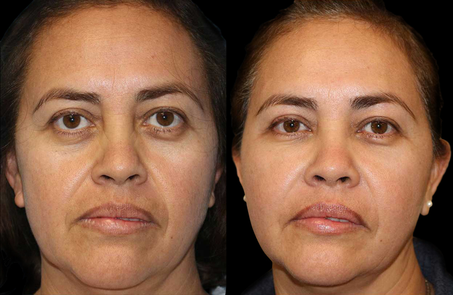 Eyelid Surgery (Blepharoplasty) Before and After Photo by Dr. Roger Tsai in Beverly Hills