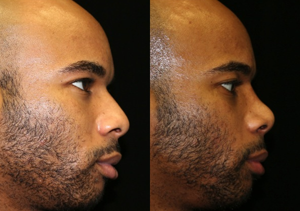 Rhinoplasty / Nose Surgery Before and After Photo by Dr. Roger Tsai in Beverly Hills