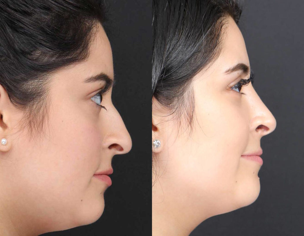 Rhinoplasty / Nose Surgery Before and After Photo by Dr. Roger Tsai in Beverly Hills