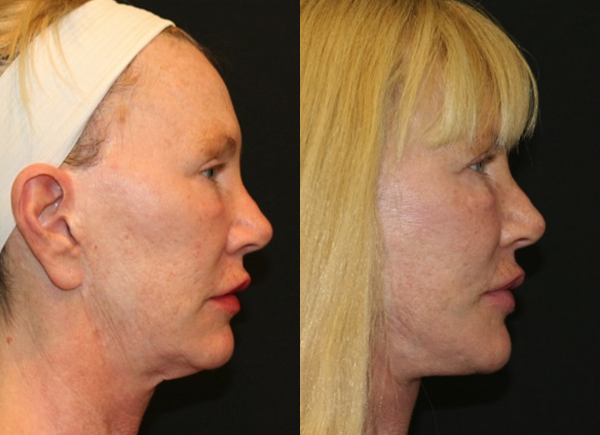 Neck Lift (Platysmaplasty) Before and After Photo by Dr. Roger Tsai in Beverly Hills