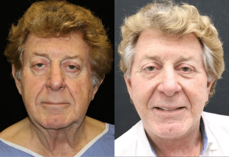 Neck Lift (Platysmaplasty) Before and After Photo by Dr. Roger Tsai in Beverly Hills