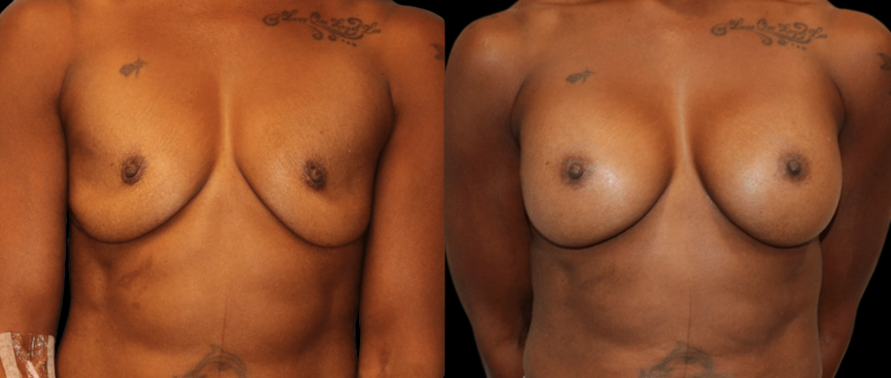 Breast Augmentation Before and After Photo by Dr. Roger Tsai in Beverly Hills