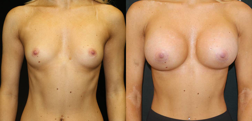 Breast Augmentation Before and After Photo by Dr. Roger Tsai in Beverly Hills