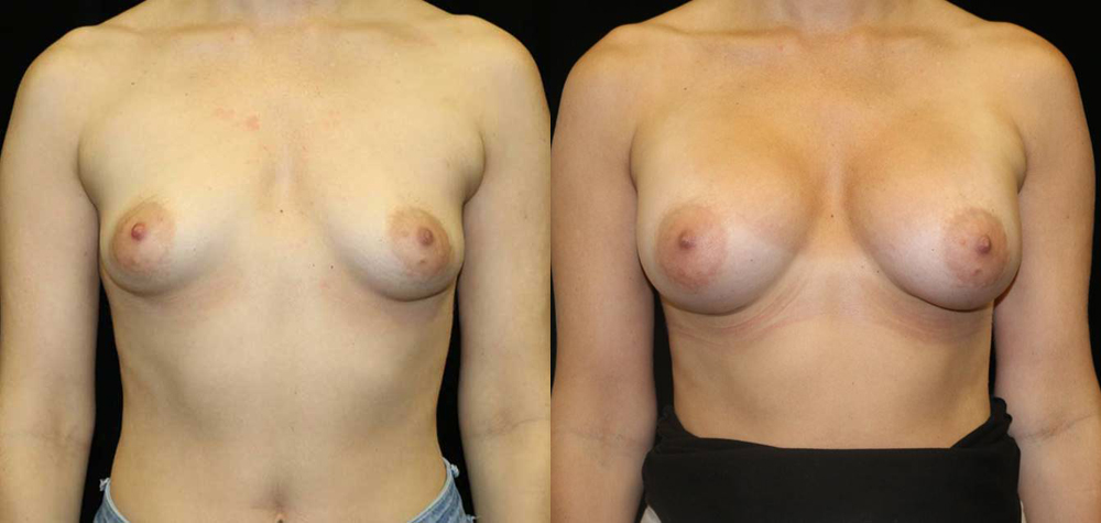 Breast Augmentation Before and After Photo by Dr. Roger Tsai in Beverly Hills