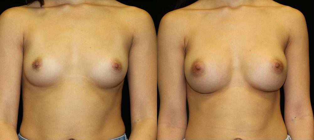 Breast Augmentation Before and After Photo by Dr. Roger Tsai in Beverly Hills