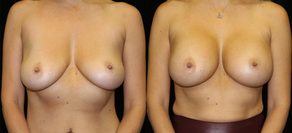 Breast Augmentation Before and After Photo by Dr. Roger Tsai in Beverly Hills