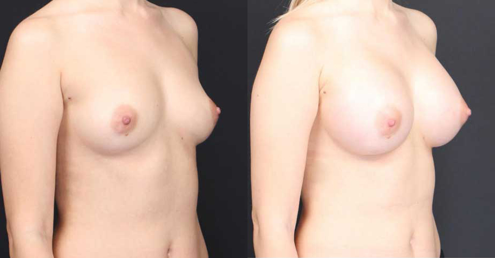 Breast Augmentation Before and After Photo by Dr. Roger Tsai in Beverly Hills