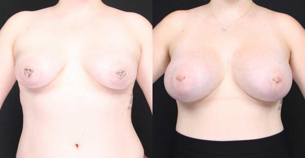 Breast Augmentation Before and After Photo by Dr. Roger Tsai in Beverly Hills