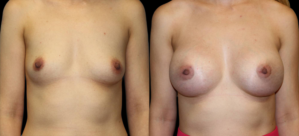 Breast Augmentation Before and After Photo by Dr. Roger Tsai in Beverly Hills