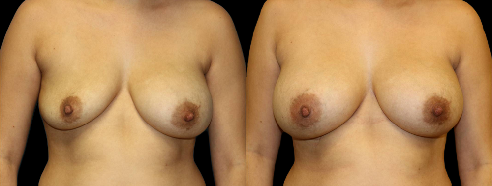 Breast Augmentation Before and After Photo by Dr. Roger Tsai in Beverly Hills