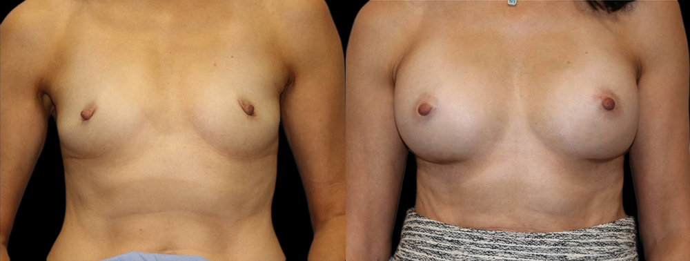 Breast Augmentation Before and After Photo by Dr. Roger Tsai in Beverly Hills