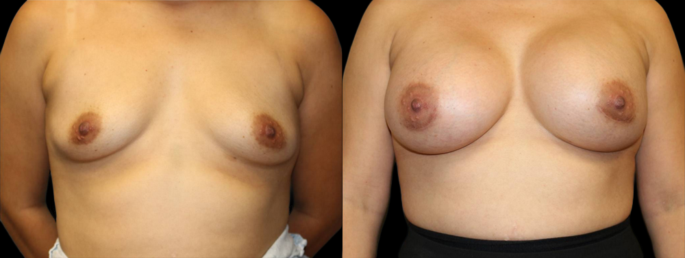 Breast Augmentation Before and After Photo by Dr. Roger Tsai in Beverly Hills