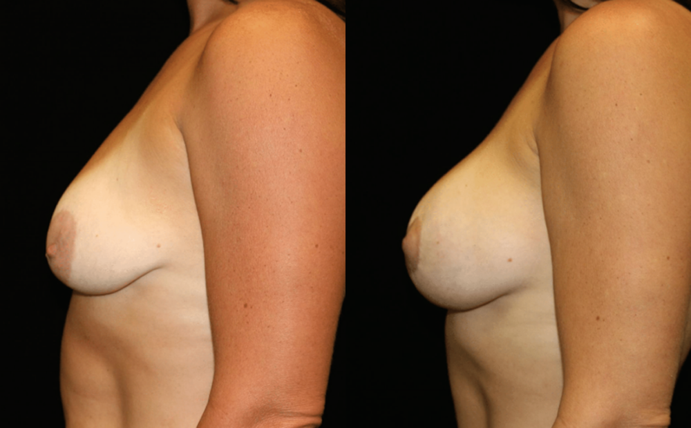 Breast Augmentation With Lift Before and After Photo by Dr. Roger Tsai in Beverly Hills