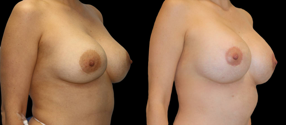 Breast Augmentation With Lift Before and After Photo by Dr. Roger Tsai in Beverly Hills