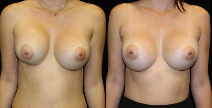 Breast Revision Before and After Photo by Dr. Roger Tsai in Beverly Hills