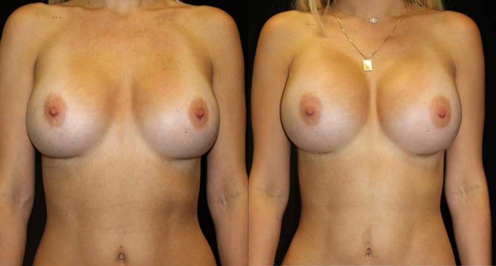 Breast Revision Before and After Photo by Dr. Roger Tsai in Beverly Hills