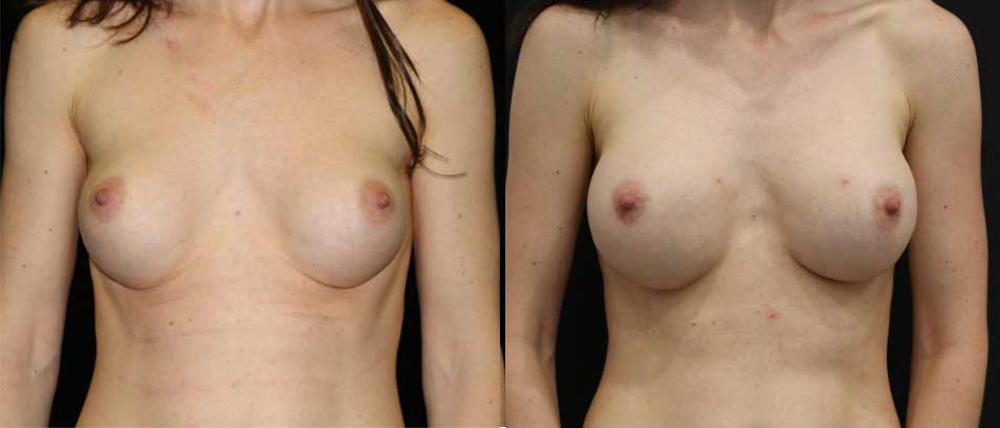 Breast Revision Before and After Photo by Dr. Roger Tsai in Beverly Hills