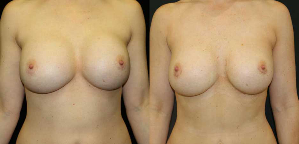 Breast Revision Before and After Photo by Dr. Roger Tsai in Beverly Hills