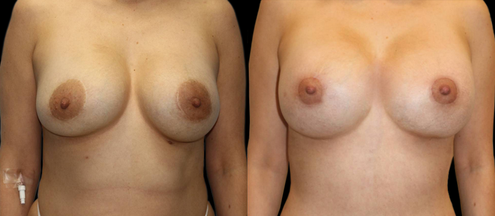 Breast Revision Before and After Photo by Dr. Roger Tsai in Beverly Hills