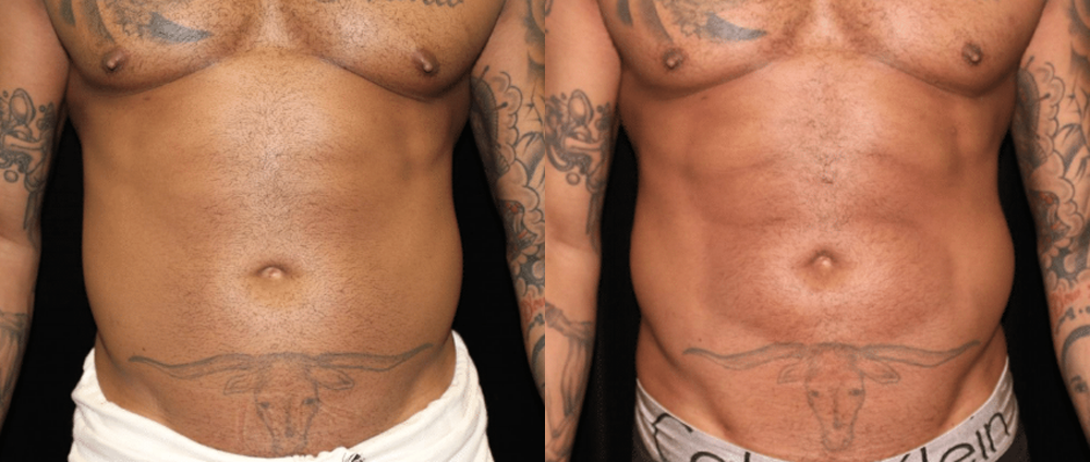 Abdominal Etching Before and After Photo by Dr. Roger Tsai in Beverly Hills