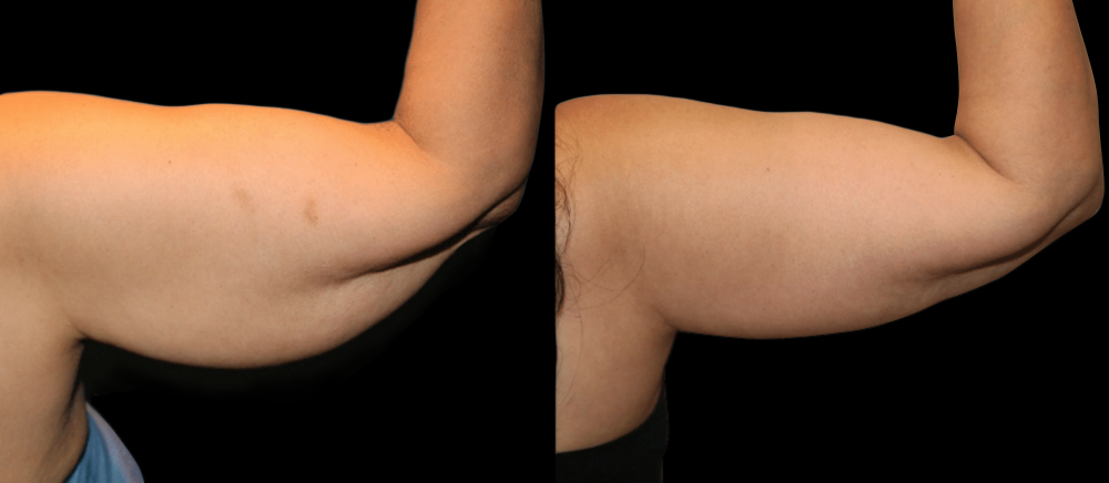 Upper Arm Lift (Brachioplasty) Before and After Photo by Dr. Roger Tsai in Beverly Hills