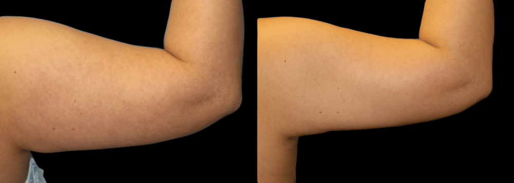 Upper Arm Lift (Brachioplasty) Before and After Photo by Dr. Roger Tsai in Beverly Hills