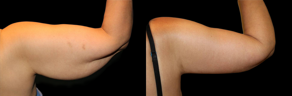 Upper Arm Lift (Brachioplasty) Before and After Photo by Dr. Roger Tsai in Beverly Hills