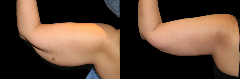 Upper Arm Lift (Brachioplasty) Before and After Photo by Dr. Roger Tsai in Beverly Hills
