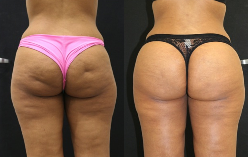Brazilian Butt Lift Before and After Photo by Dr. Roger Tsai in Beverly Hills