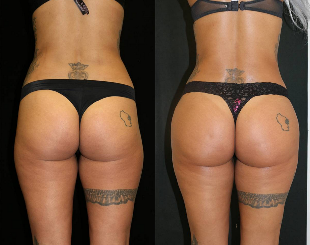 Brazilian Butt Lift Before and After Photo by Dr. Roger Tsai in Beverly Hills