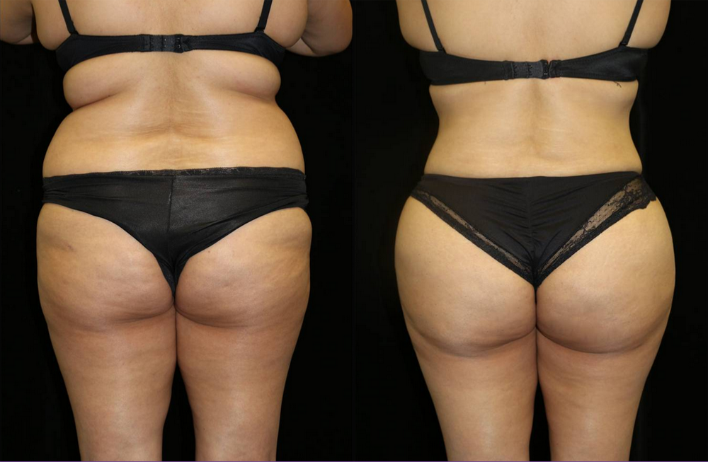 Brazilian Butt Lift Before and After Photo by Dr. Roger Tsai in Beverly Hills