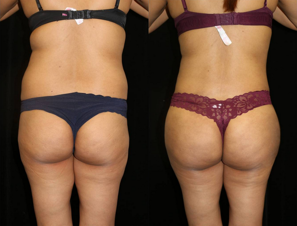 Brazilian Butt Lift Before and After Photo by Dr. Roger Tsai in Beverly Hills