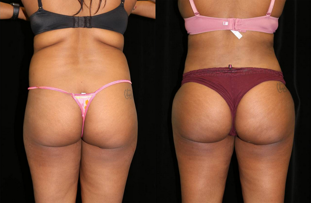 Brazilian Butt Lift Before and After Photo by Dr. Roger Tsai in Beverly Hills