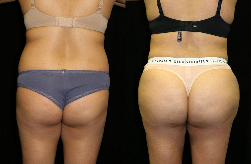 Brazilian Butt Lift Before and After Photo by Dr. Roger Tsai in Beverly Hills