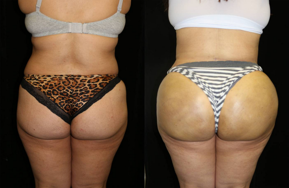 Brazilian Butt Lift Before and After Photo by Dr. Roger Tsai in Beverly Hills