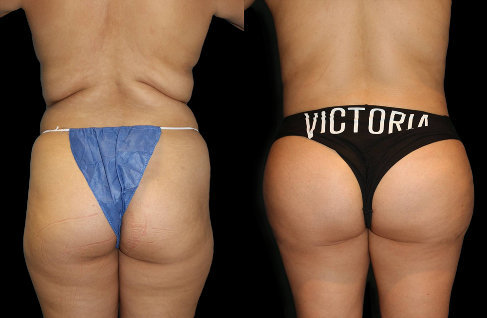 Brazilian Butt Lift Before and After Photo by Dr. Roger Tsai in Beverly Hills