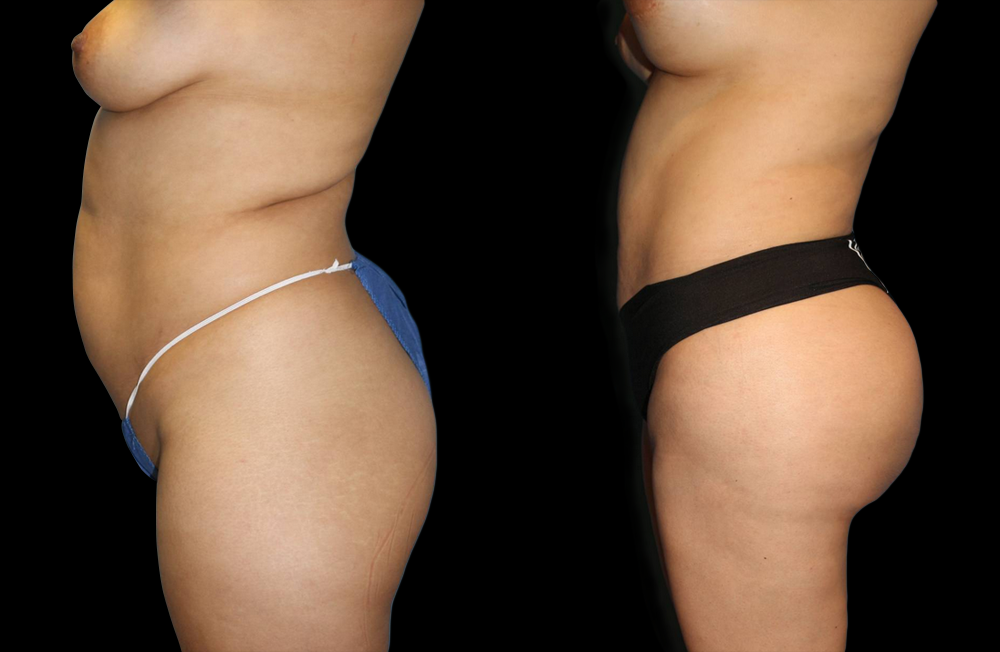 Brazilian Butt Lift Before and After Photo by Dr. Roger Tsai in Beverly Hills