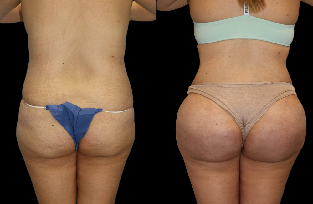 Brazilian Butt Lift Before and After Photo by Dr. Roger Tsai in Beverly Hills